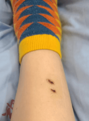 皇冠信用網会员开户
_女子在云南被银环蛇咬伤打了十多支血清皇冠信用網会员开户
，自称2年后仍有后遗症：头晕脸麻，没想到恢复得这么慢