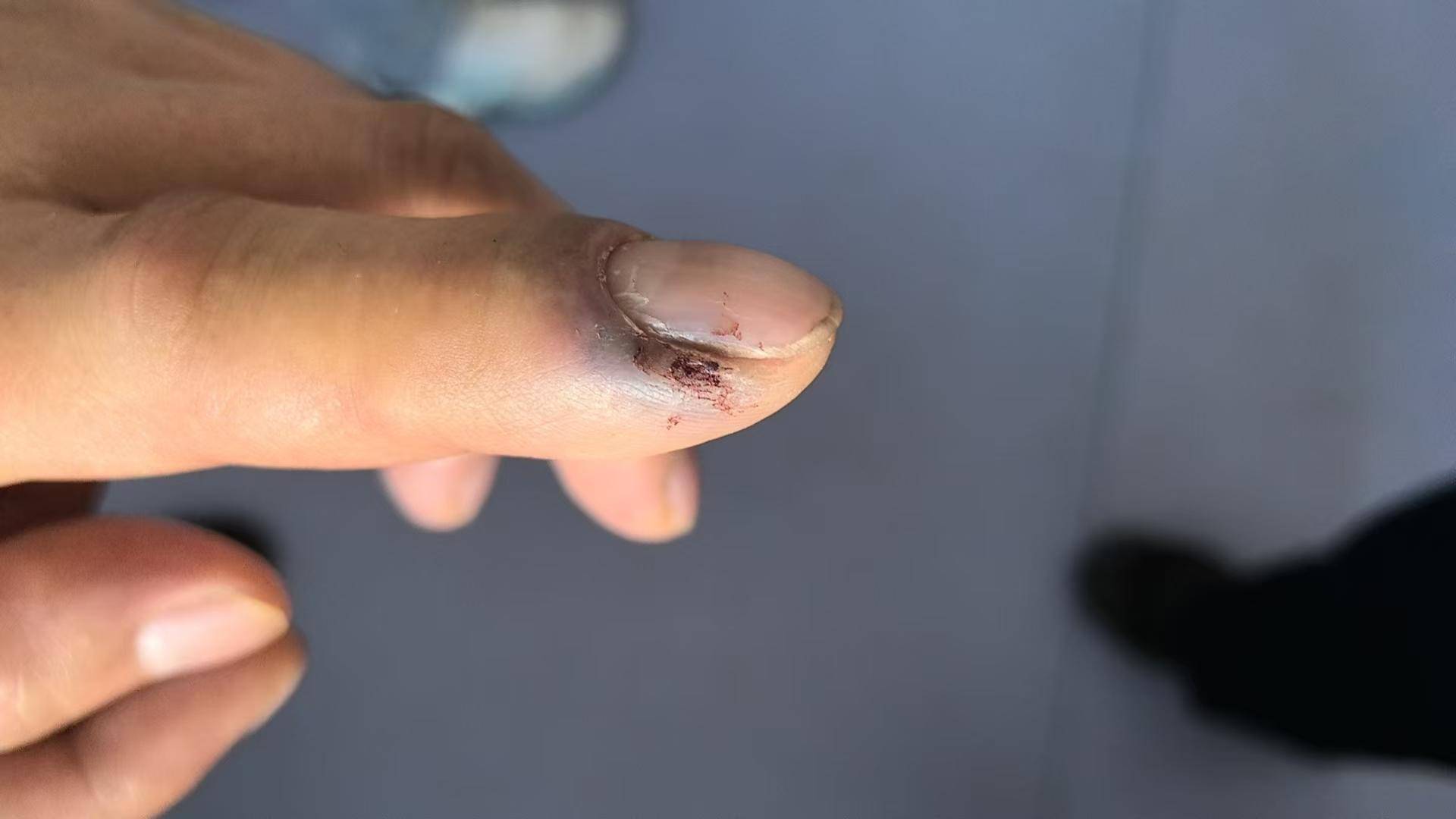 皇冠信用会员账号注册_青海一男子被罕见剧毒阿拉善蝮蛇咬伤皇冠信用会员账号注册,因无血清一度想放弃治疗 警车开道转运700公里救命